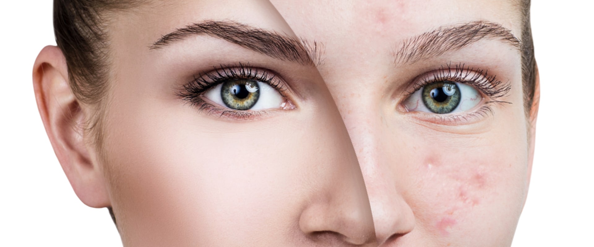 Effective Strategies for Reducing Acne and Breakouts