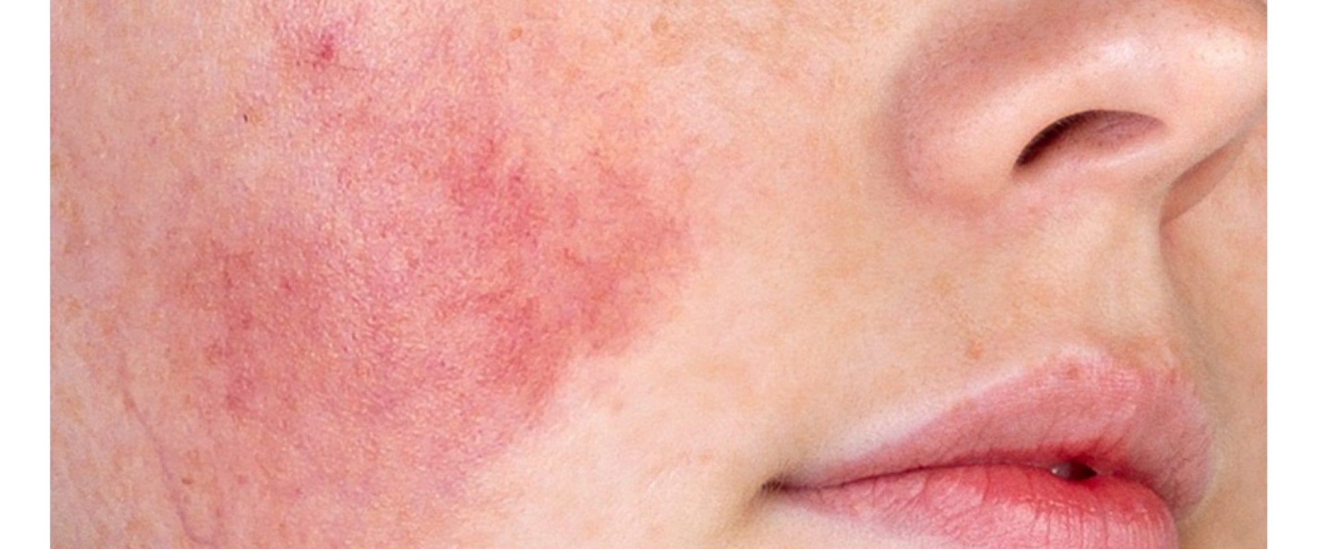 Sensitive Skin Considerations for Facial Treatments