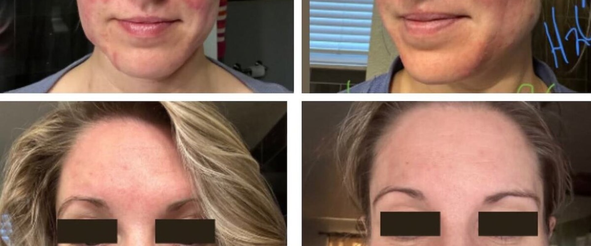 Transformative Journeys: Real Client Facials Before and After