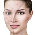 Effective Strategies for Reducing Acne and Breakouts
