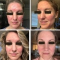 Transformative Journeys: Real Client Facials Before and After