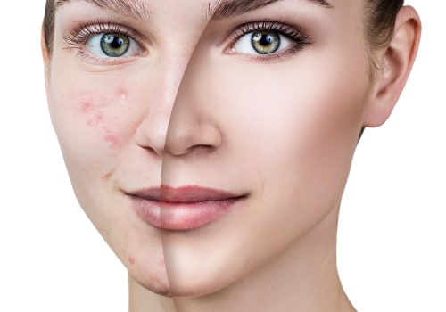 Effective Strategies for Reducing Acne and Breakouts