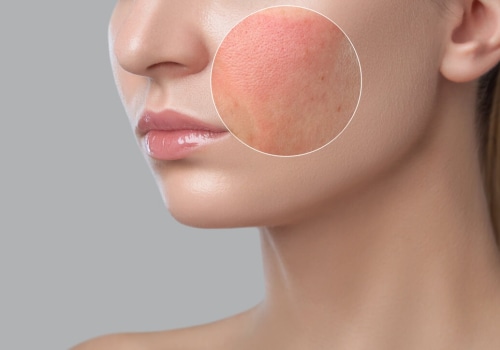 Understanding Immediate Reactions After a Facial Treatment