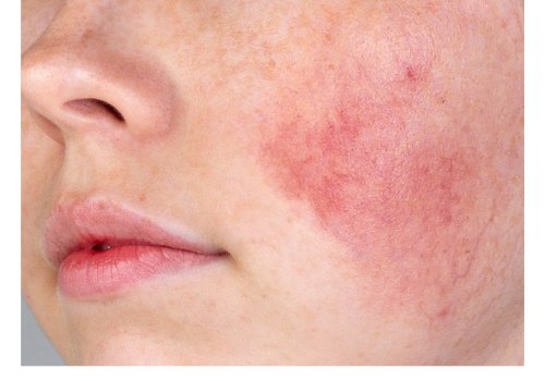 Sensitive Skin Considerations for Facial Treatments