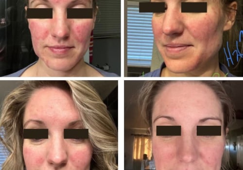 Transformative Journeys: Real Client Facials Before and After